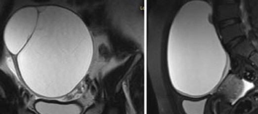 OVARIAN DERMOID CYST