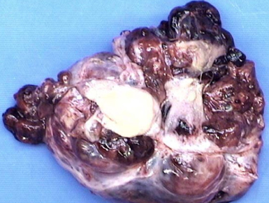 OVARIAN DERMOID CYST