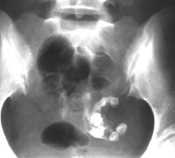 OVARIAN DERMOID CYST