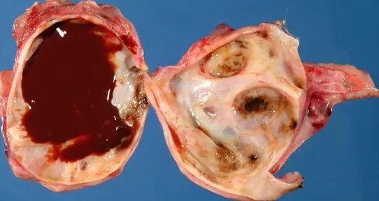 OVARIAN ENDOMETRIAL CYST