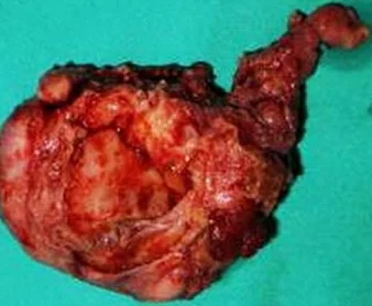 OVARIAN ENDOMETRIOMA