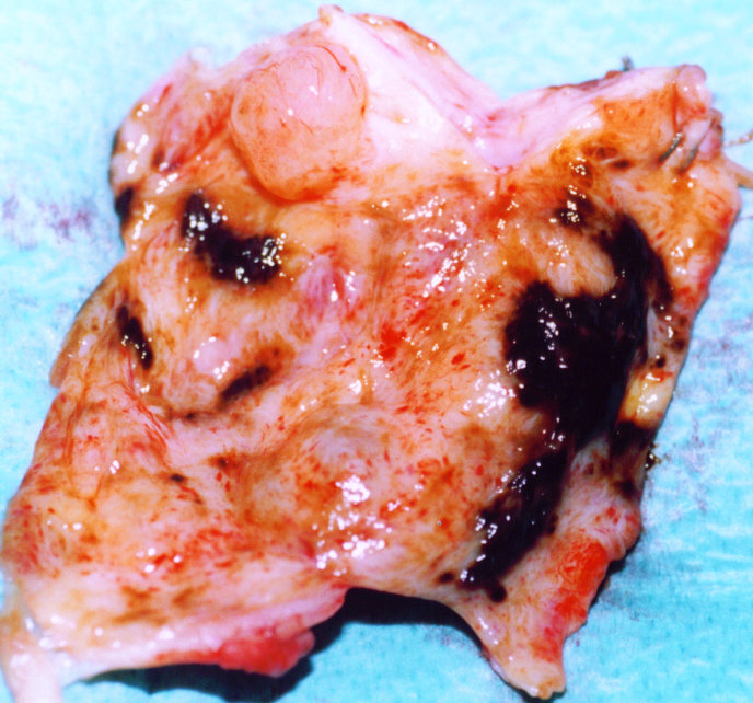 OVARIAN ENDOMETRIOSIS