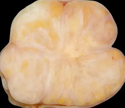 OVARIAN FIBROMA
