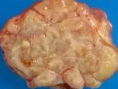 OVARIAN LEIOMYOMA