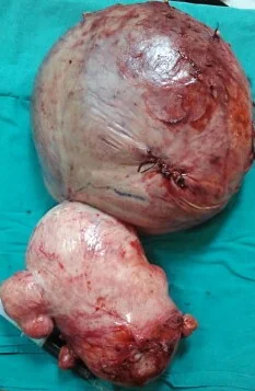 OVARIAN LEIOMYOMA