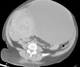 OVARIAN LEIOMYOMA
