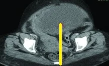 OVARIAN LYMPHOMA