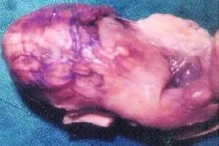 OVARIAN LYMPHOMA