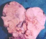 CROSS SECTION OVARIAN LYMPHOMA
