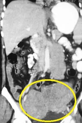 OVARIAN LYMPHOMA