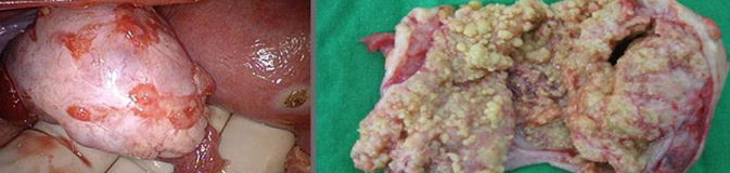 OVARIAN METASTASIS