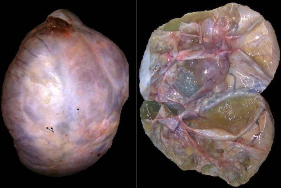 OVARIAN METASTASIS
