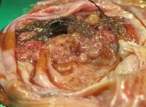 OVARIAN TERATOMA - MALIGNANT TRANSFORMATION
