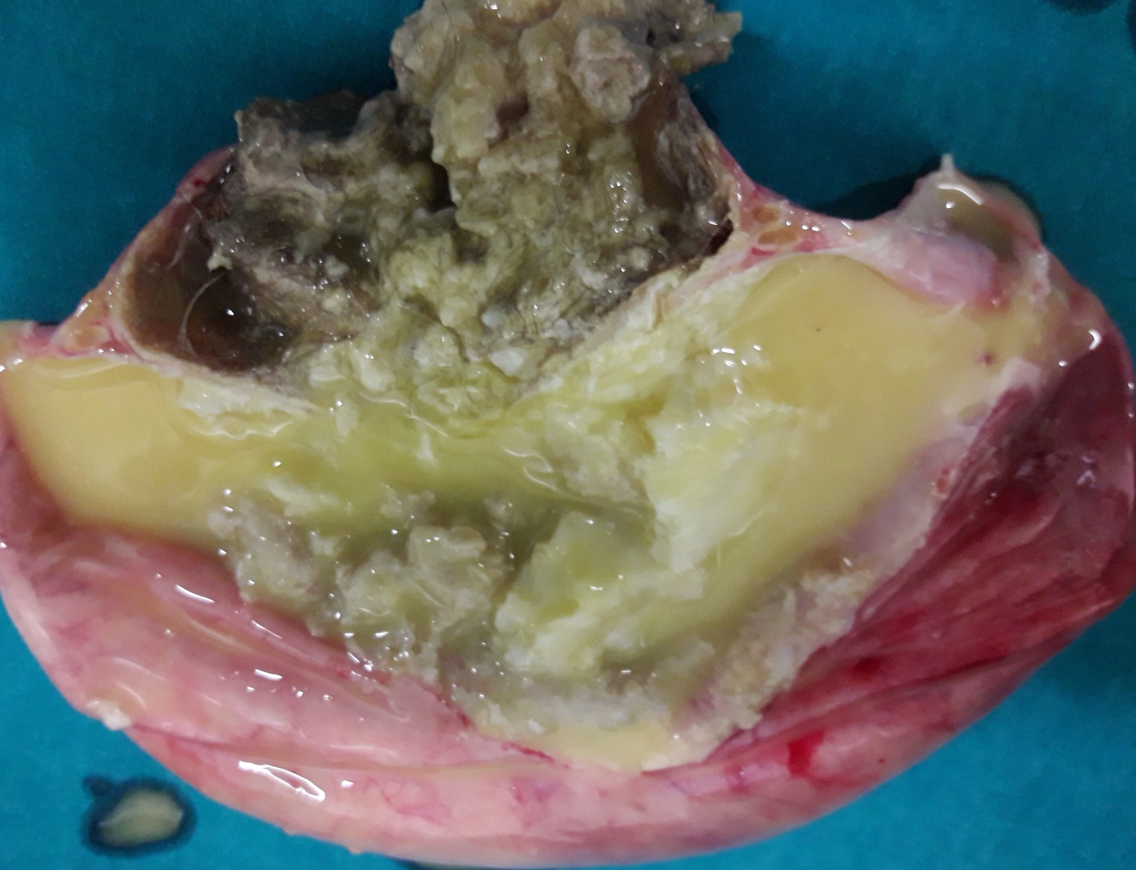OVARIAN TERATOMA