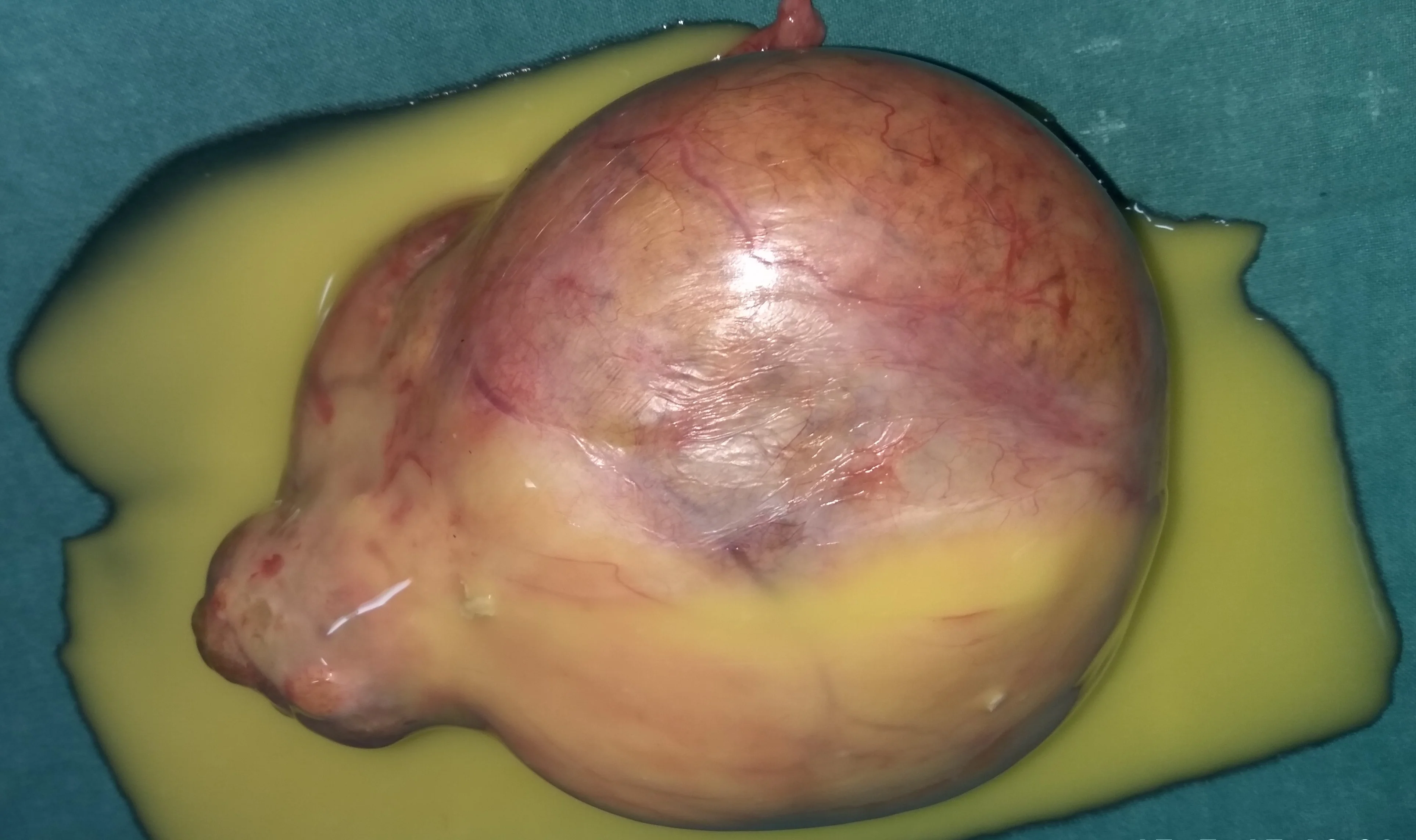 OVARIAN TERATOMA