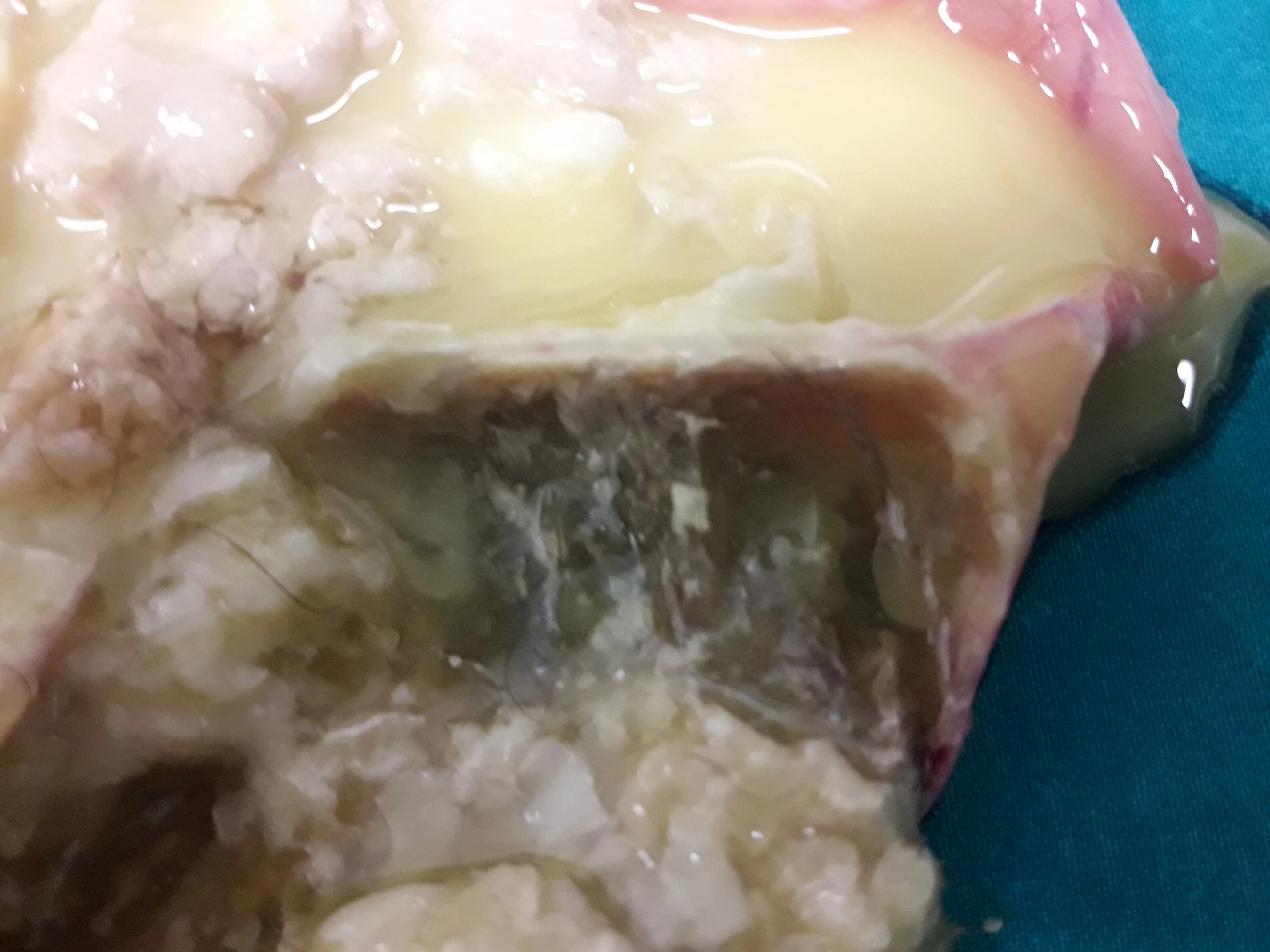 OVARIAN TERATOMA