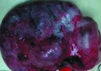 OVARIAN TERATOMA