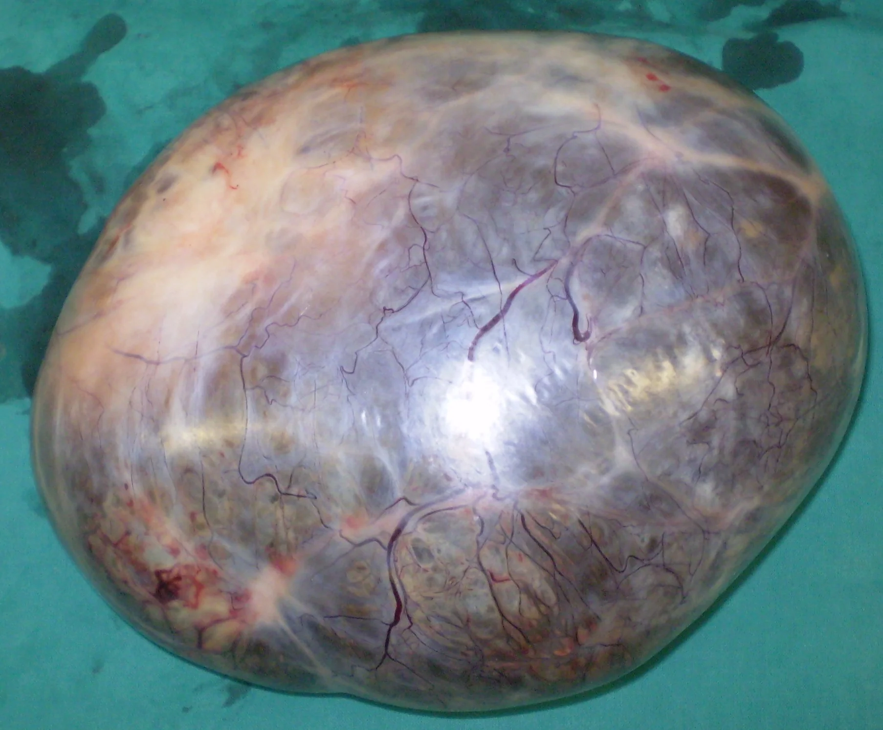SEROUS CYSTADENOMA