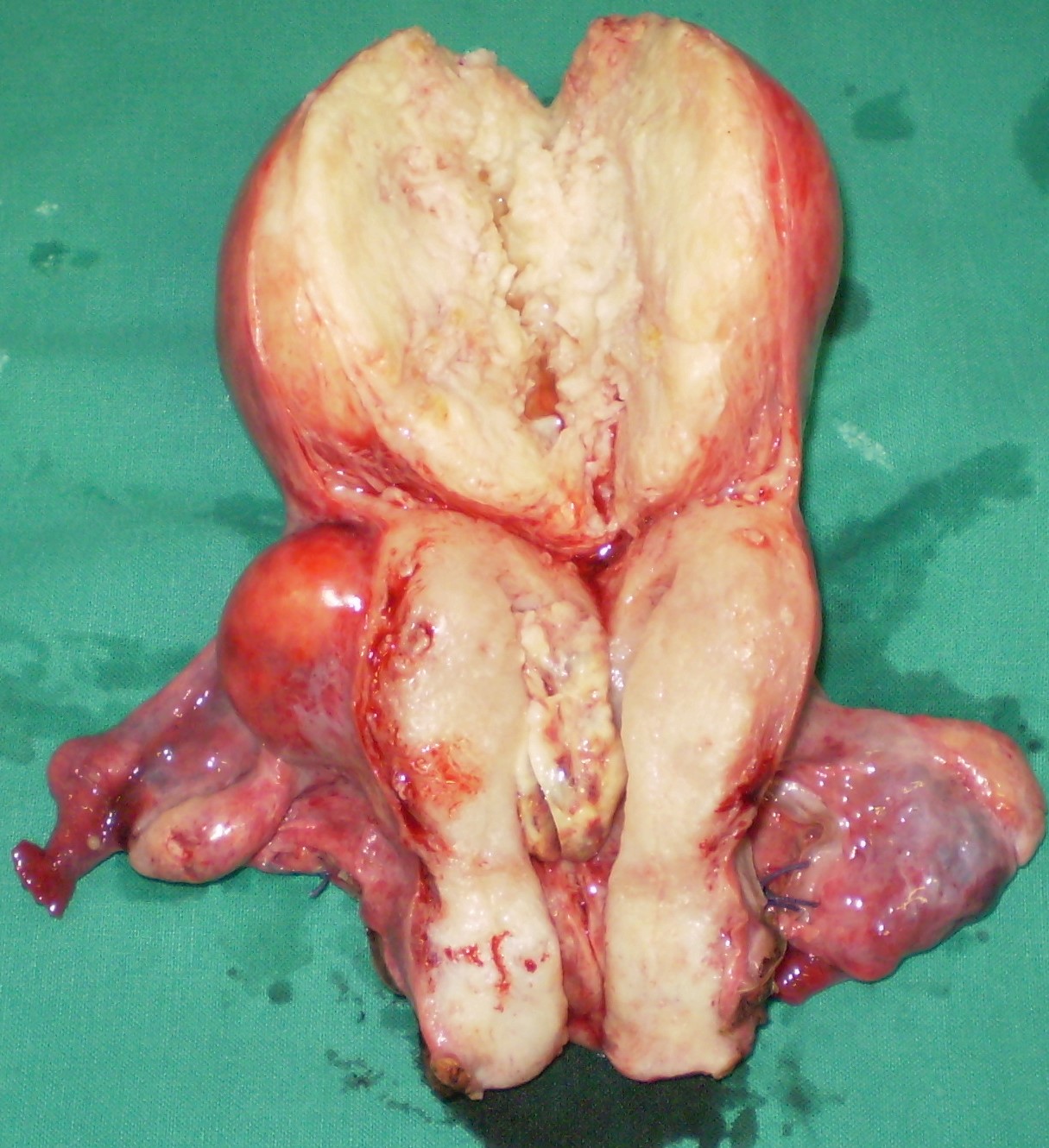 TOTAL HYSTERECTOMY - FIBROIDS