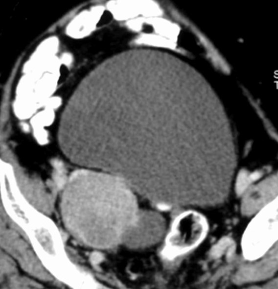 PAPILLARY ADENOCARCINOMA OVARY 