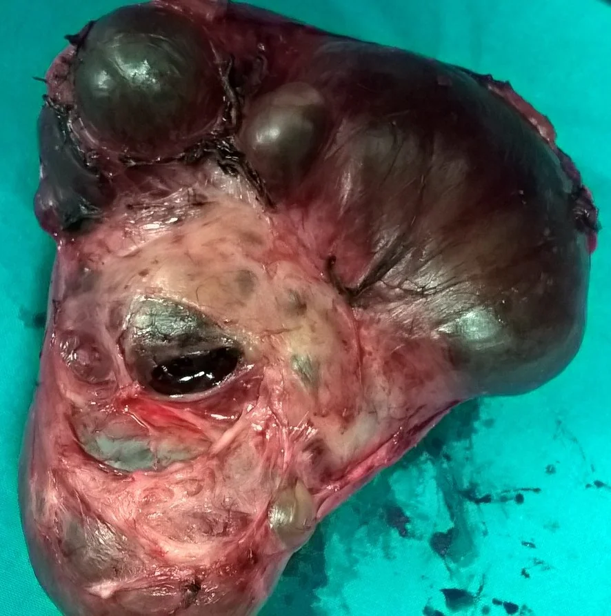 PARAOVARIAN CYST