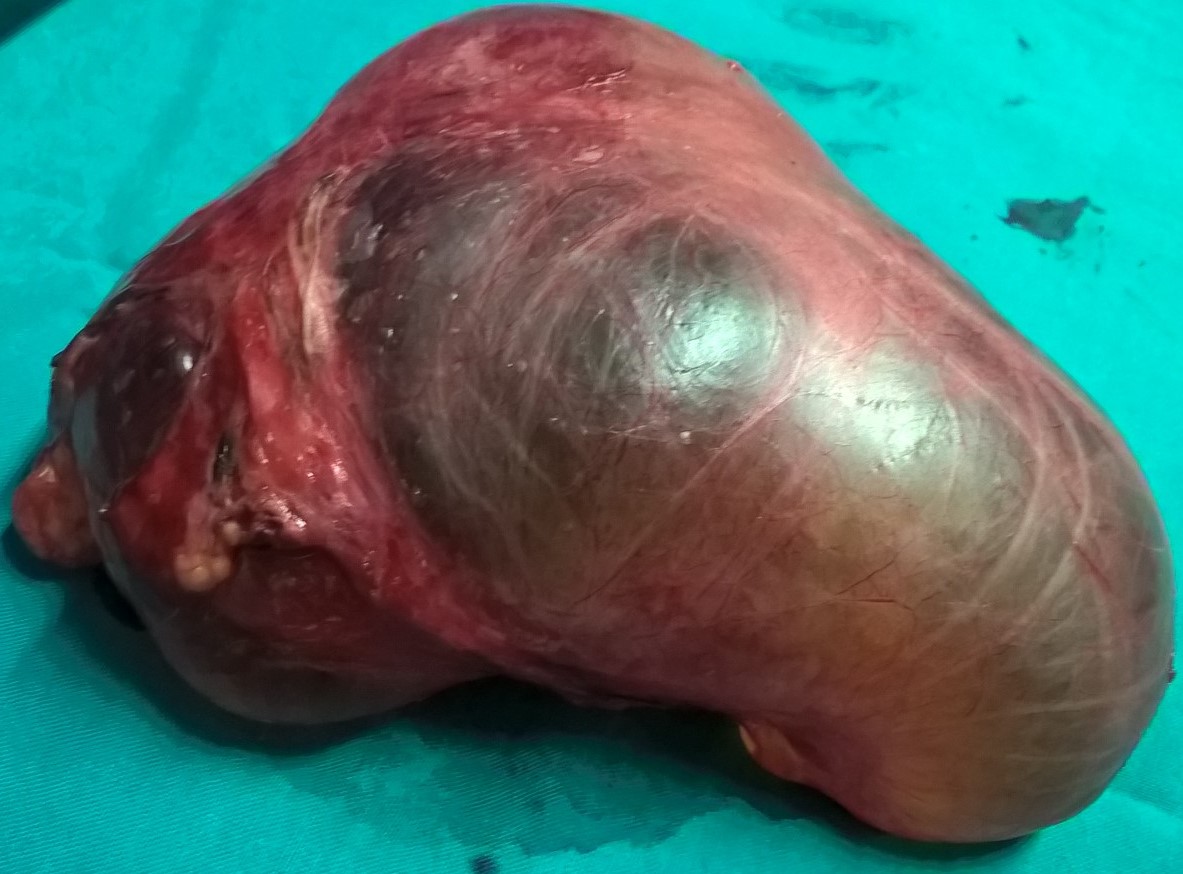 PARAOVARIAN CYST