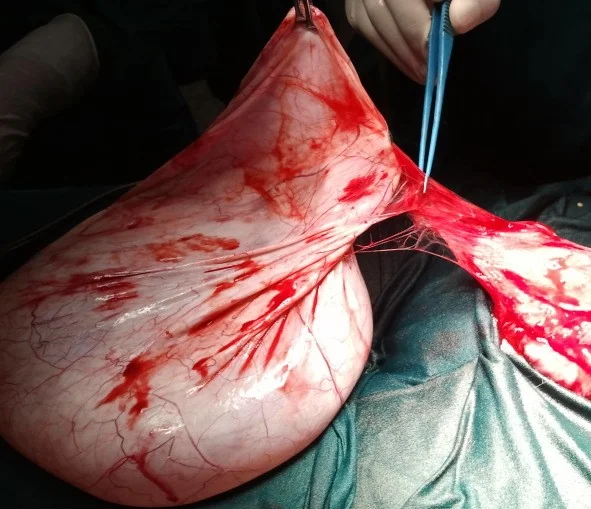 PARAOVARIAN CYST