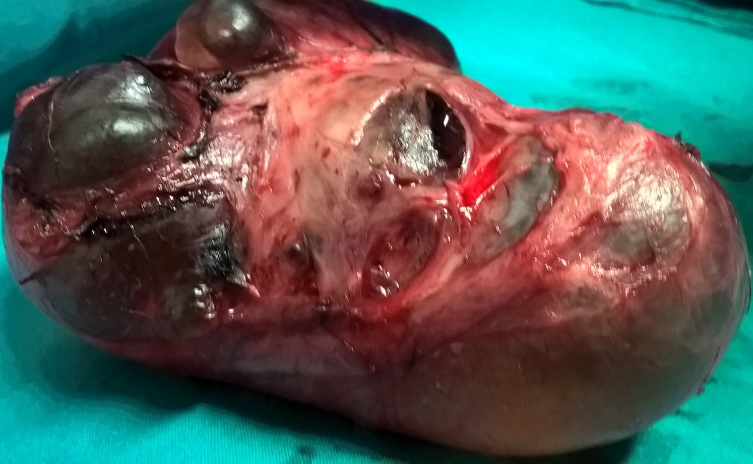 PARAOVARIAN CYST 