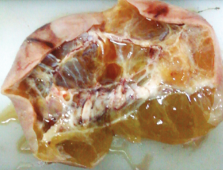 PARAOVARIAN LEIOMYOMA