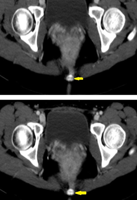 PERINEAL ENDOMETRIOSIS