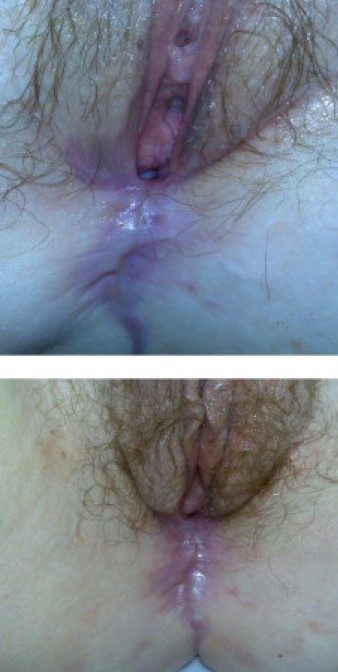 PERINEAL ENDOMETRIOSIS