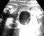 PRENATAL OVARIAN CYST