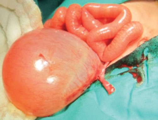 PRENATAL OVARIAN CYST