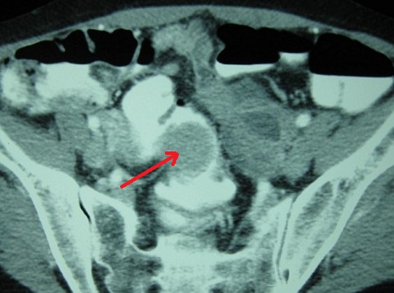 RECTAL OBSTRUCTION - ENDOMETRIOSIS