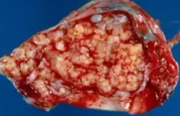 SEROUS BORDERLINE TUMOR
