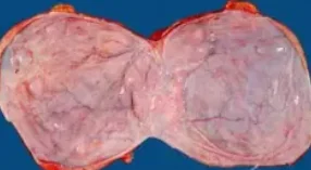 SEROUS CYSTADENOMA