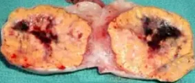 STEROID CELL TUMOR