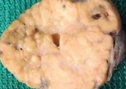 STEROID CELL TUMOR 
