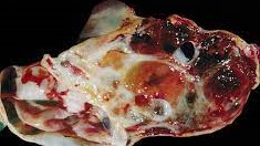 STRUMA OVARII TUMOR