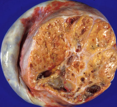 OVARIAN TERATOMA