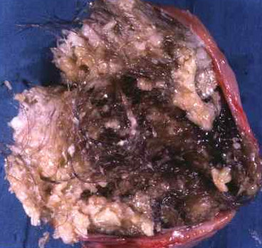OVARIAN TERATOMA