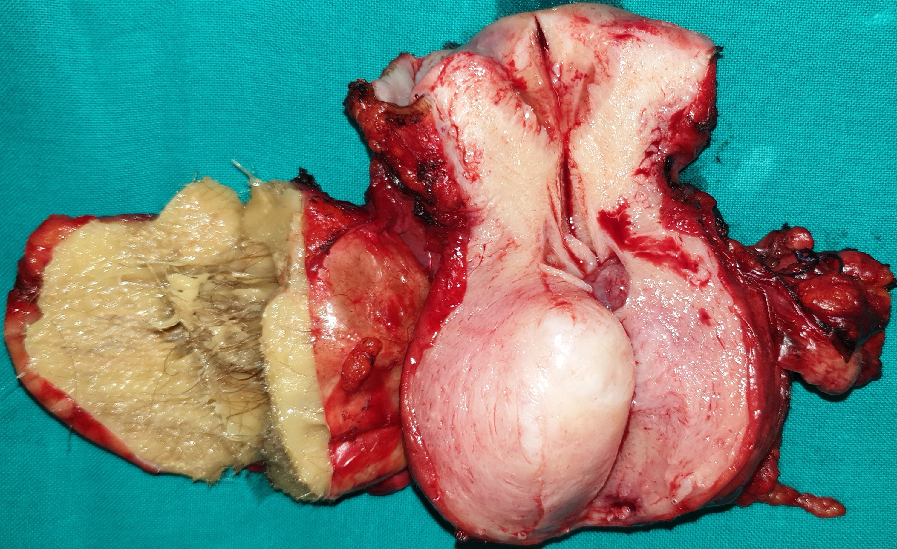 OVARIAN TERATOMA + UTERINE FIBROID