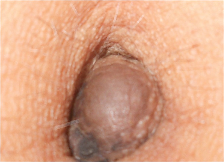 UMBILICAL ENDOMETRIOSIS