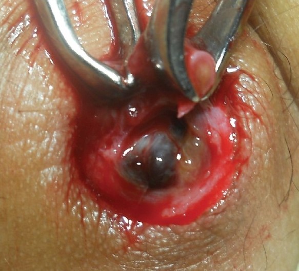 UMBILICAL ENDOMETRIOSIS 