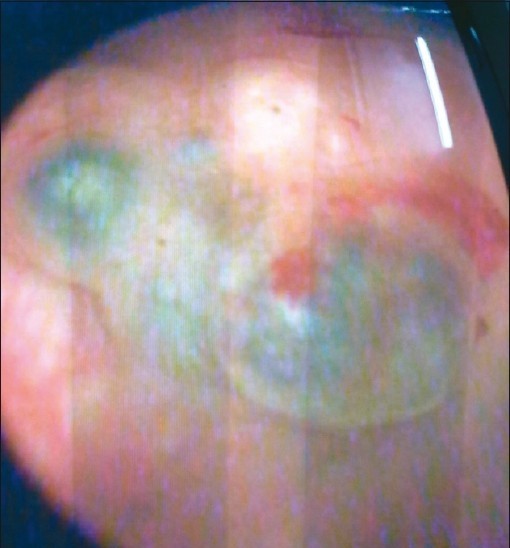 URINARY TRACT ENDOMETRIOSIS - CYSTOSCOPY