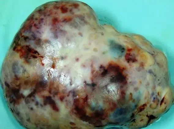 YOLK SAC TUMOR