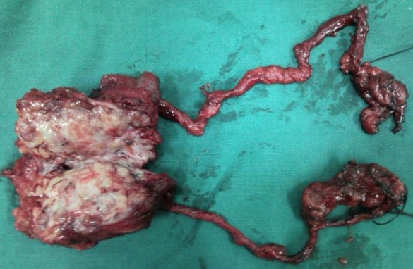 YOLK SAC TUMOR 