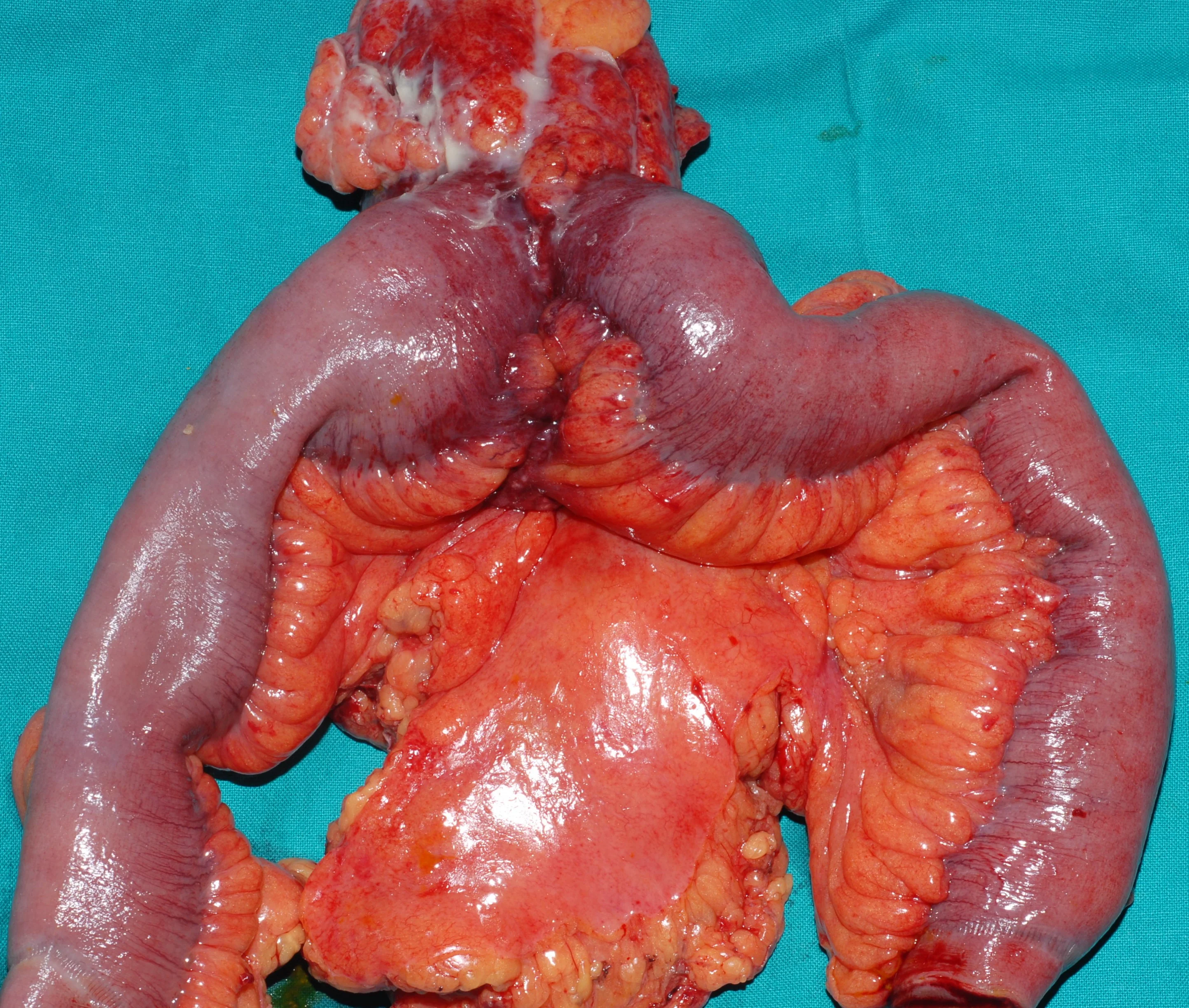 SMALL BOWEL STENOSIS
