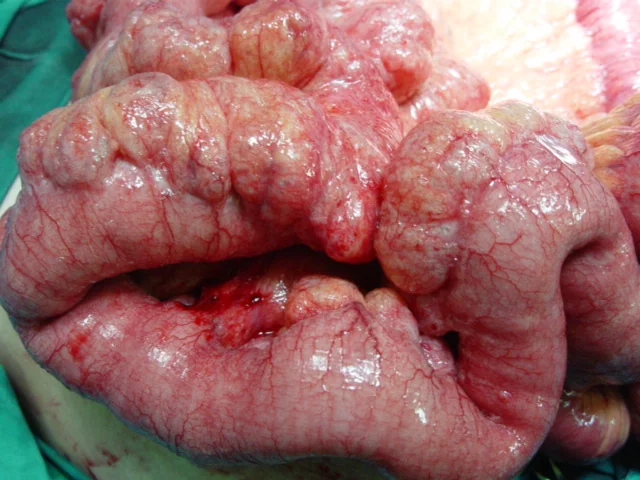 INTESTINAL PNEUMATOSIS