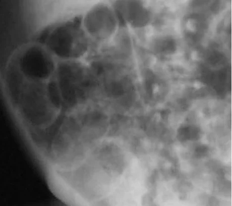 PNEUMATOSIS INTESTINALIS